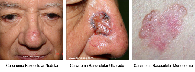 Tipos de Carcinoma Basocelular