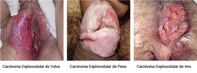 Carcinoma Espinocelular en Genitales