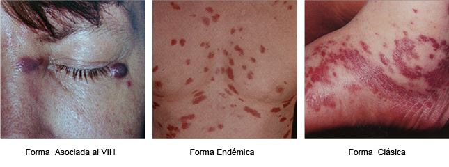 SARCOMA DE KAPOSI