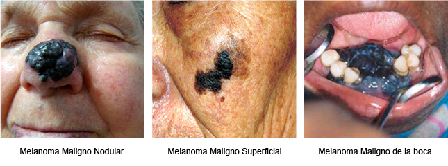 Melanoma Maligno